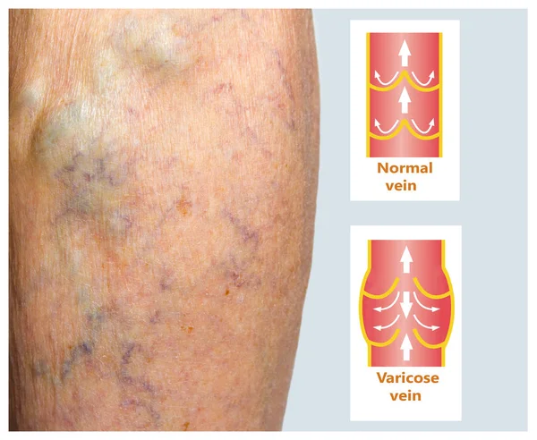 Venas varicosas en una pierna mayor femenina — Foto de Stock