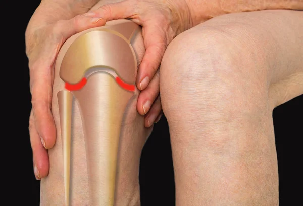 Seniorin hält sich vor Schmerzen das Knie — Stockfoto