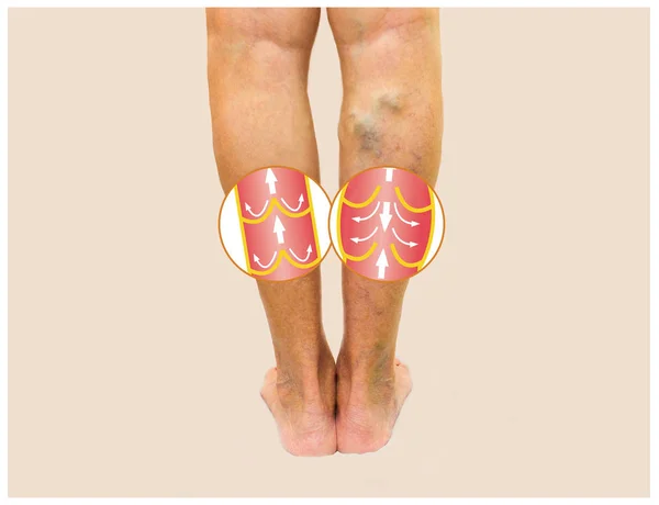 Варикозные вены на старшей ноге женщины — стоковое фото