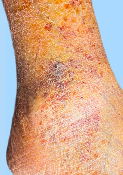 Close-up of skin with varicose veins — Stock Photo, Image