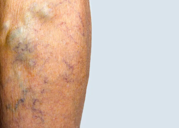 Veias varicosas em uma perna — Fotografia de Stock