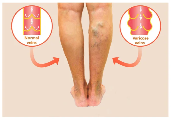 Varicose veins on a female senior leg — Stock Photo, Image