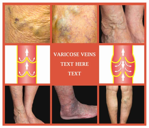 Vene varicose su una gamba anziana femminile — Foto Stock