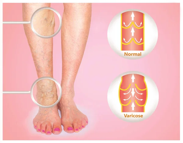 Venas varicosas en una pierna mayor femenina —  Fotos de Stock