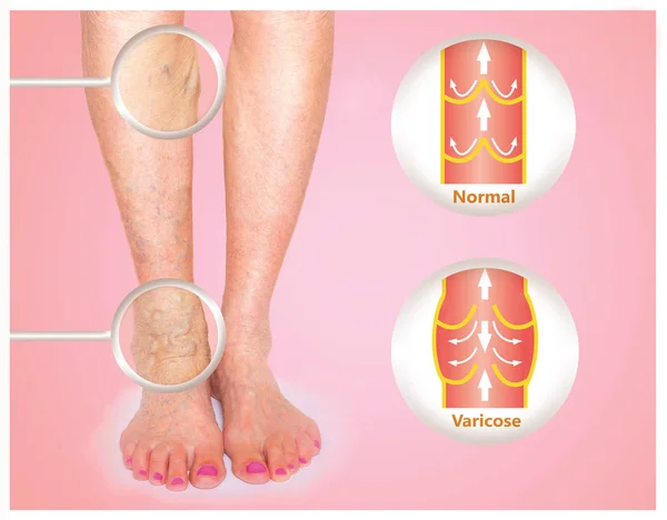 Varicose veins on a female senior leg