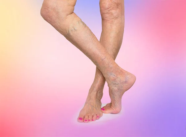 Le gambe femminili con vene ragno varicoso — Foto Stock