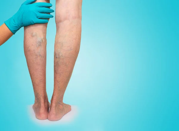 Lower limb vascular examination because suspect of venous insufficiency — Stock Photo, Image