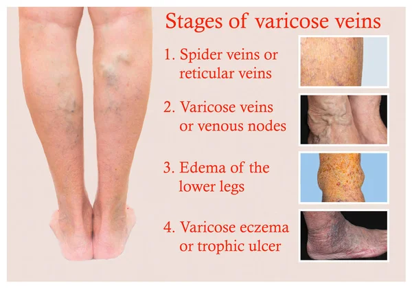 Veias varicosas em uma perna sênior feminina — Fotografia de Stock