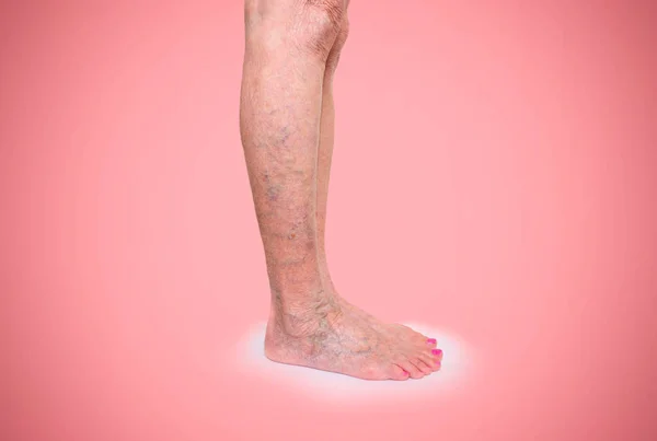 Krampfadern an weiblichen Beinen — Stockfoto