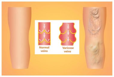 Bir kadın kıdemli bacakta varis