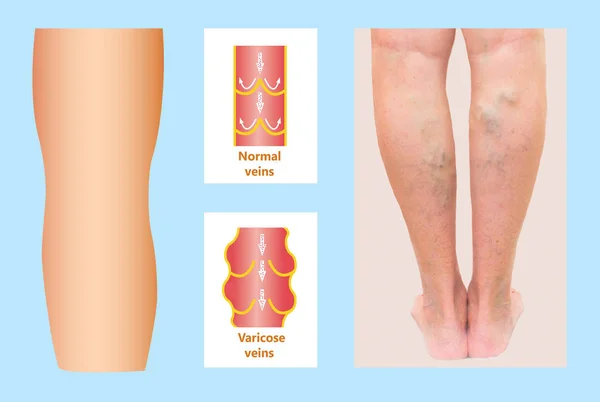 Varicose veins on a female senior leg