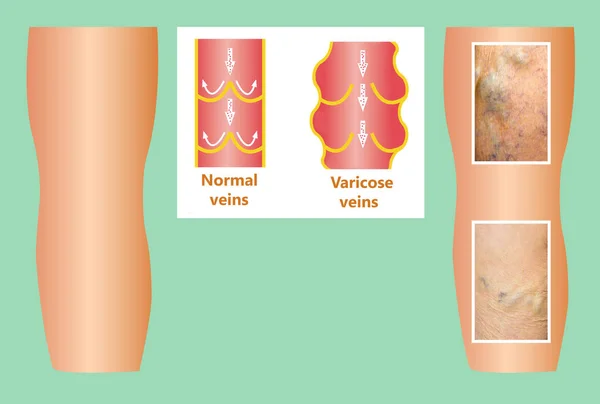 Varicose veins on a female senior leg