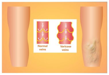 Bir kadın kıdemli bacakta varis