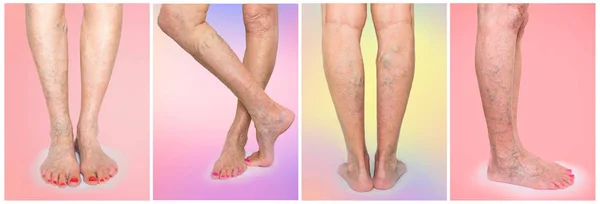 Die weiblichen Beine mit Venen Krampfadern Spinne. Collage — Stockfoto