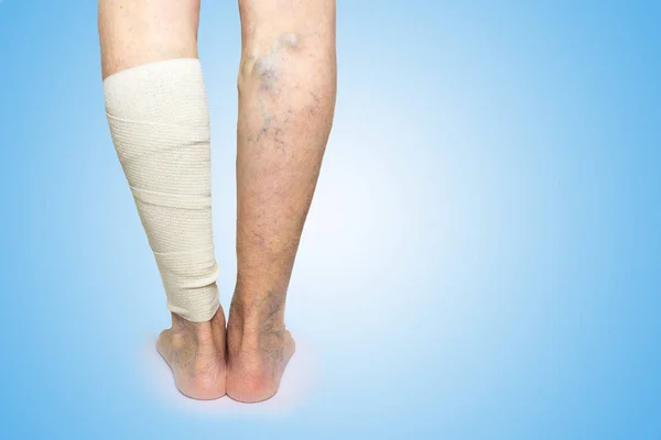 Ben. Åderbråck. Phlebeurysm. Tromboflebit. Elastisk bandage — Stockfoto