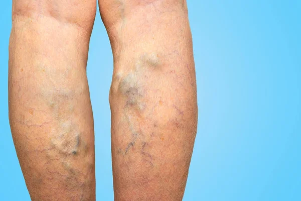 Varicose veins on a female legs — Stock Photo, Image