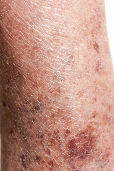Primer plano de la piel con varices —  Fotos de Stock