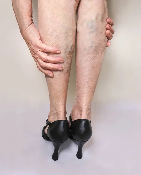 Dolorose vene varicose e ragno sulle gambe femminili.Donna in tacchi massaggiare gambe stanche — Foto Stock