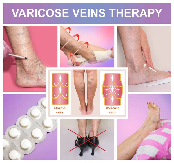 Treatment of varicose veins — Stock Photo, Image