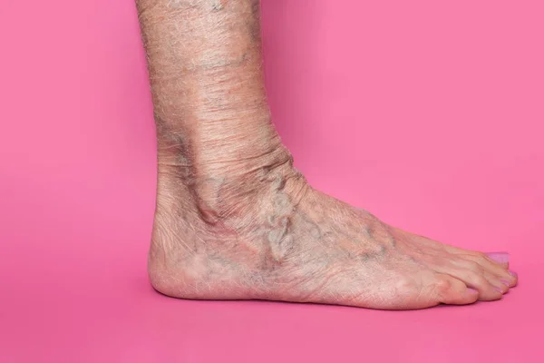 Vene varicose su gambe femminili — Foto Stock
