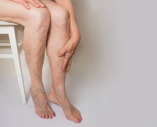 Vene varicose su gambe femminili — Foto Stock