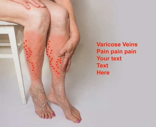 Vene varicose su gambe femminili — Foto Stock