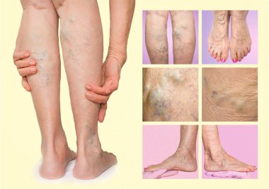 Painful varicose veins,,spider veins, varices on a severely affected leg. Ageing, old age disease, aesthetic problem concept. clipart