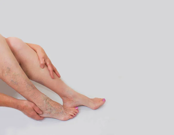 Bir kadın ayak üzerinde varisli damarlar — Stok fotoğraf