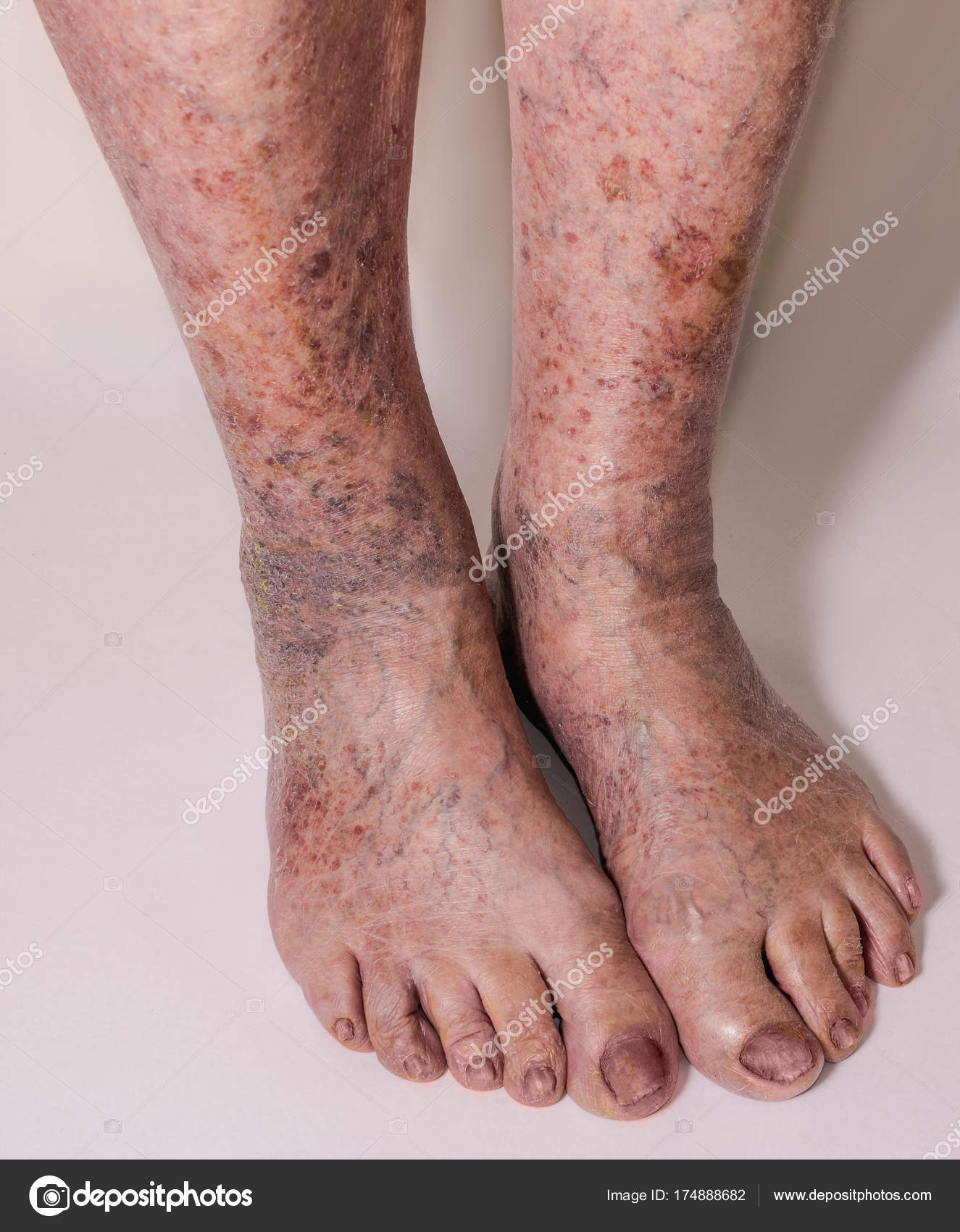 Kazahstan tratamentul varicoz. Unguent eficient pentru varicele picioarelor