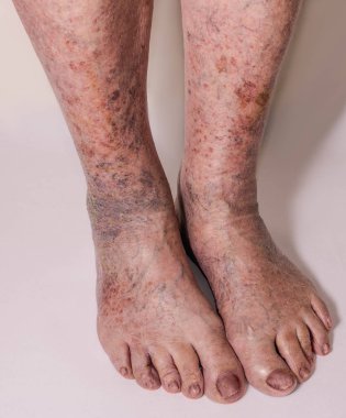 Varisli damarlar ile cilt Close-Up