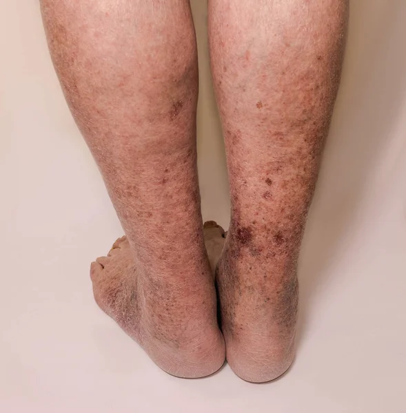 Close-up of skin with varicose veins — Stock Photo, Image