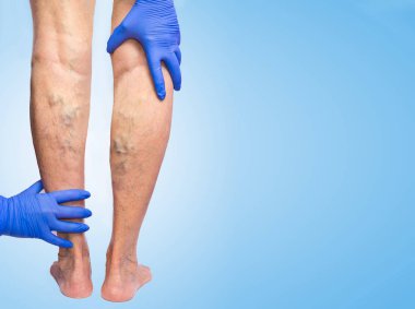 Lower limb vascular examination because suspect of venous insufficiency clipart