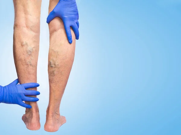 Lower limb vascular examination because suspect of venous insufficiency