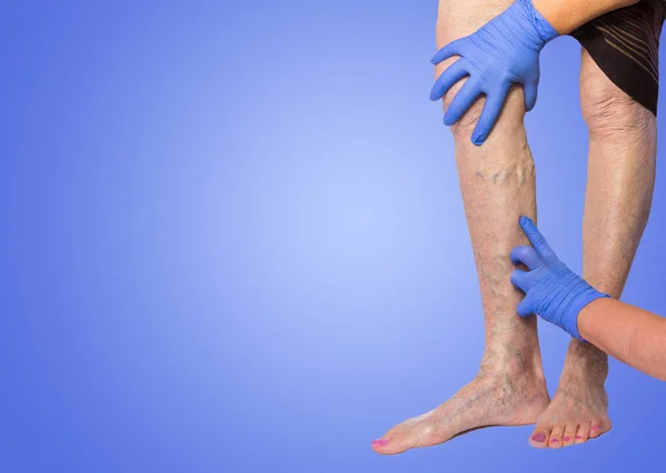alt ekstremite vasküler sınavı çünkü Venöz Yetmezlik, şüpheli
