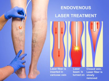 Varicose Veins and laser clipart