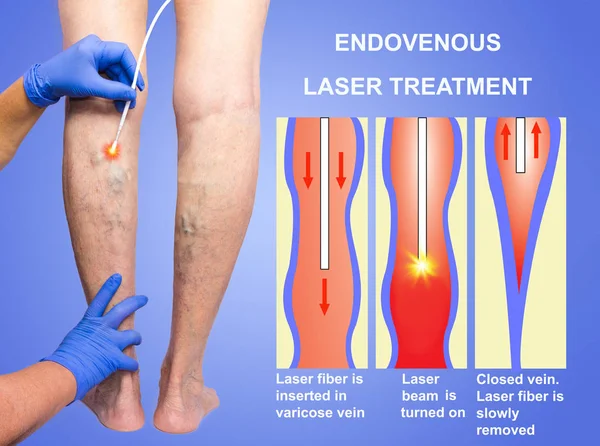 Křečové žíly a laser — Stock fotografie