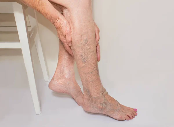 Варикозные вены на женских ногах — стоковое фото