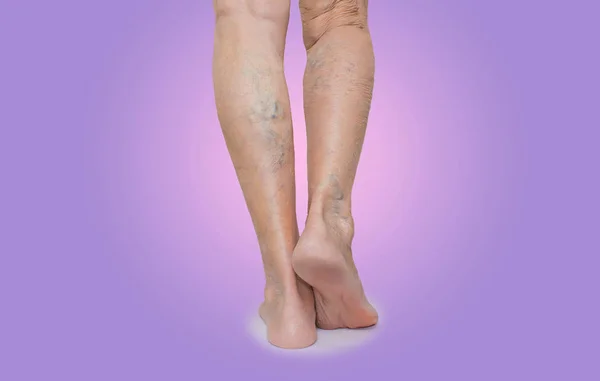 Les jambes féminines avec des veines varices araignée — Photo