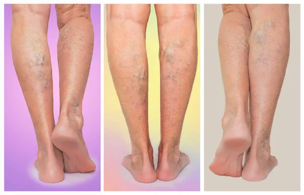 De vrouwelijke benen met aderen spataderen spin. Collage — Stockfoto