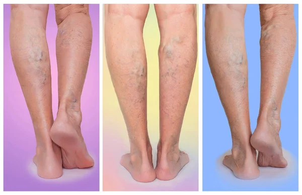 Las piernas femeninas con venas varicosas araña. Collage. —  Fotos de Stock