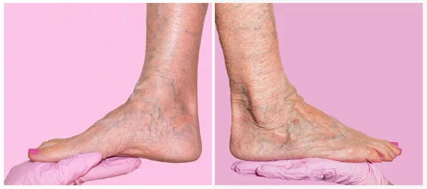 Lower limb vascular examination because suspect of venous insufficiency.