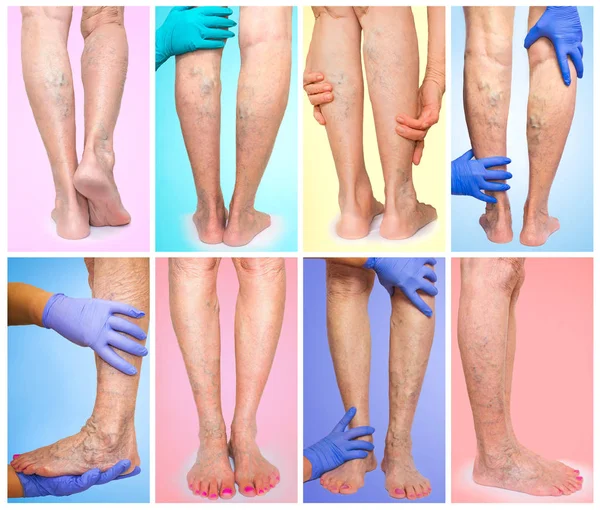 The female legs with veins varicose spider. Collage — Stock Photo, Image