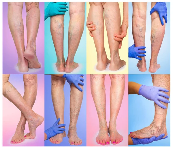 As pernas femininas com veias aranha varicosa. Colagem — Fotografia de Stock