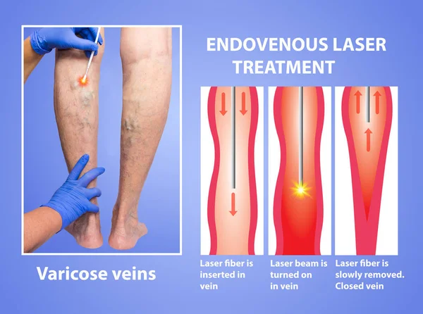 Εξωγκόμενος φλέβες και το laser — Φωτογραφία Αρχείου