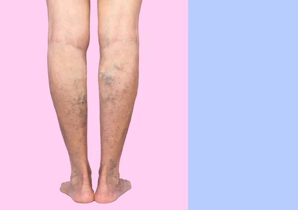 Les jambes féminines avec des veines varices araignée — Photo