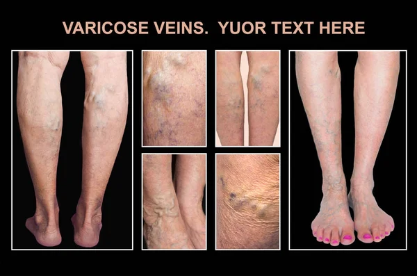 Painful varicose veins,,spider veins, varices on a severely affected leg. Ageing, old age disease, aesthetic problem concept.