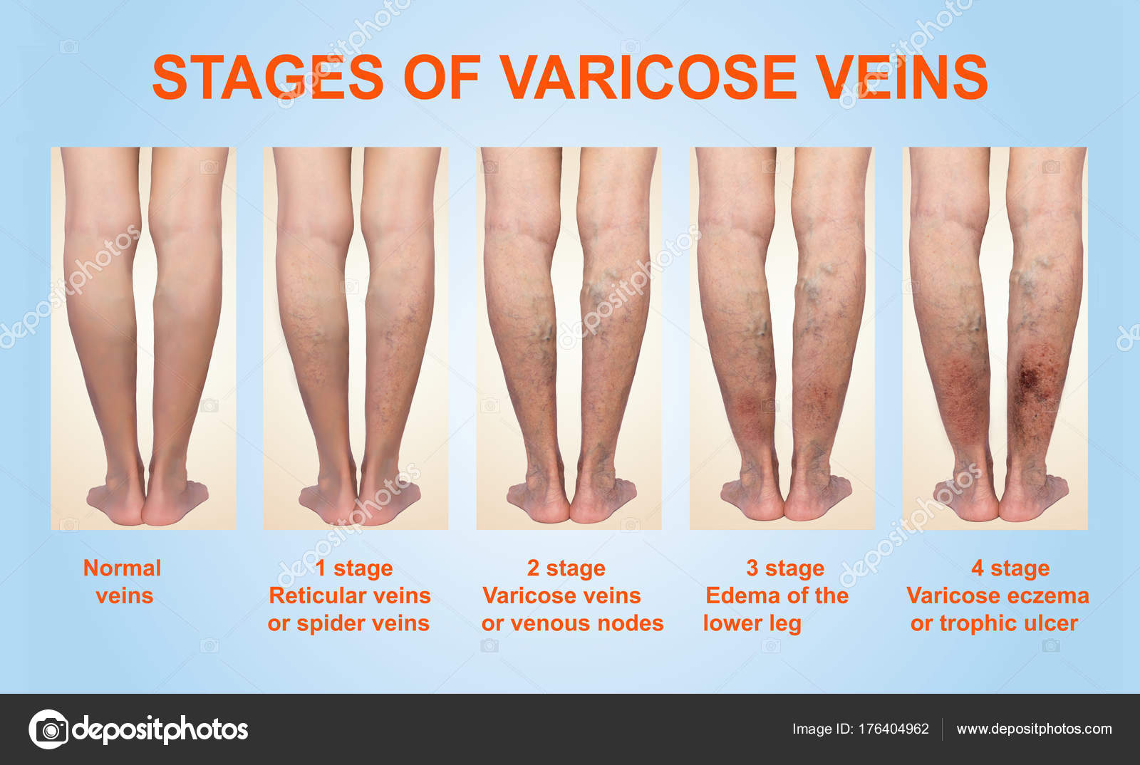 varicoza osteopatie