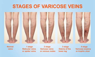 Bir kadın kıdemli bacakta varis