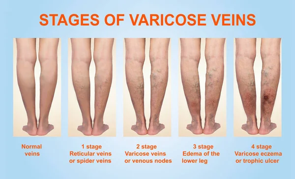 Varicose veins on a female senior leg