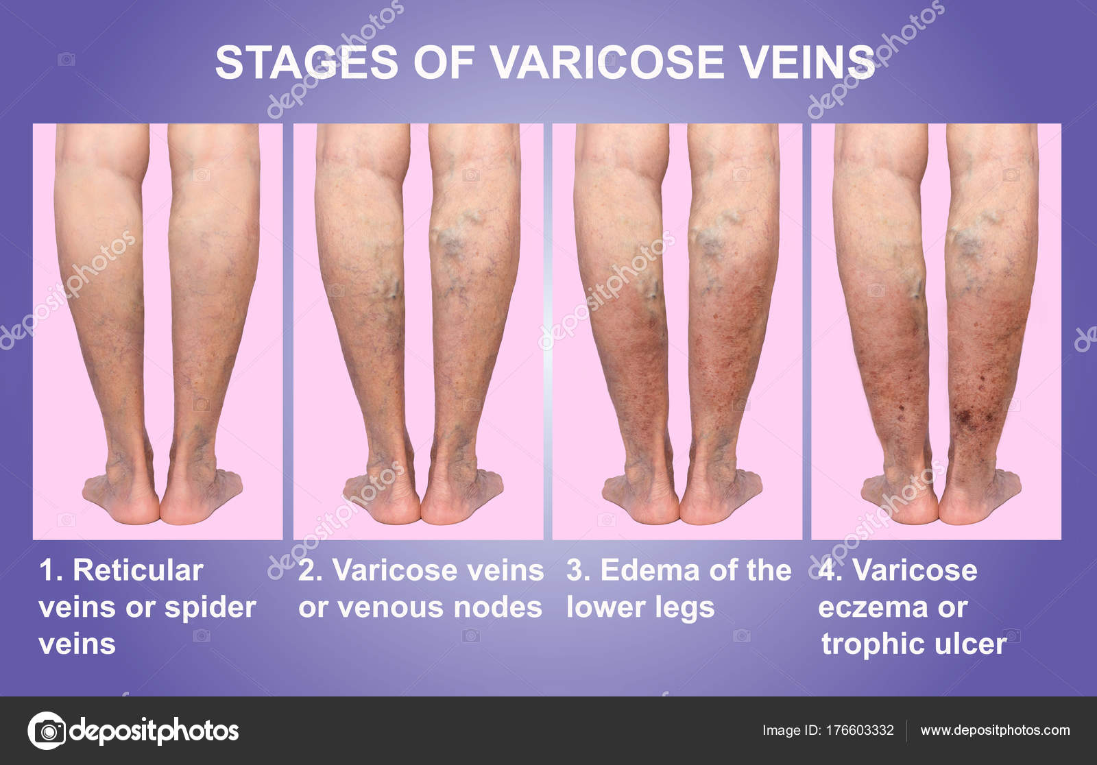 Procedimento Para Desentupir Veias Da Perna Veias varicosas em uma perna sênior feminina Stock Photo © Marina113